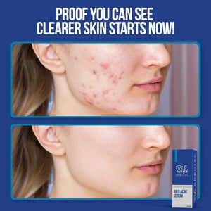 Wiki Special Anti Acne Serum – 30ml | Clears Acne, Soothes Skin & Fights Blemishes